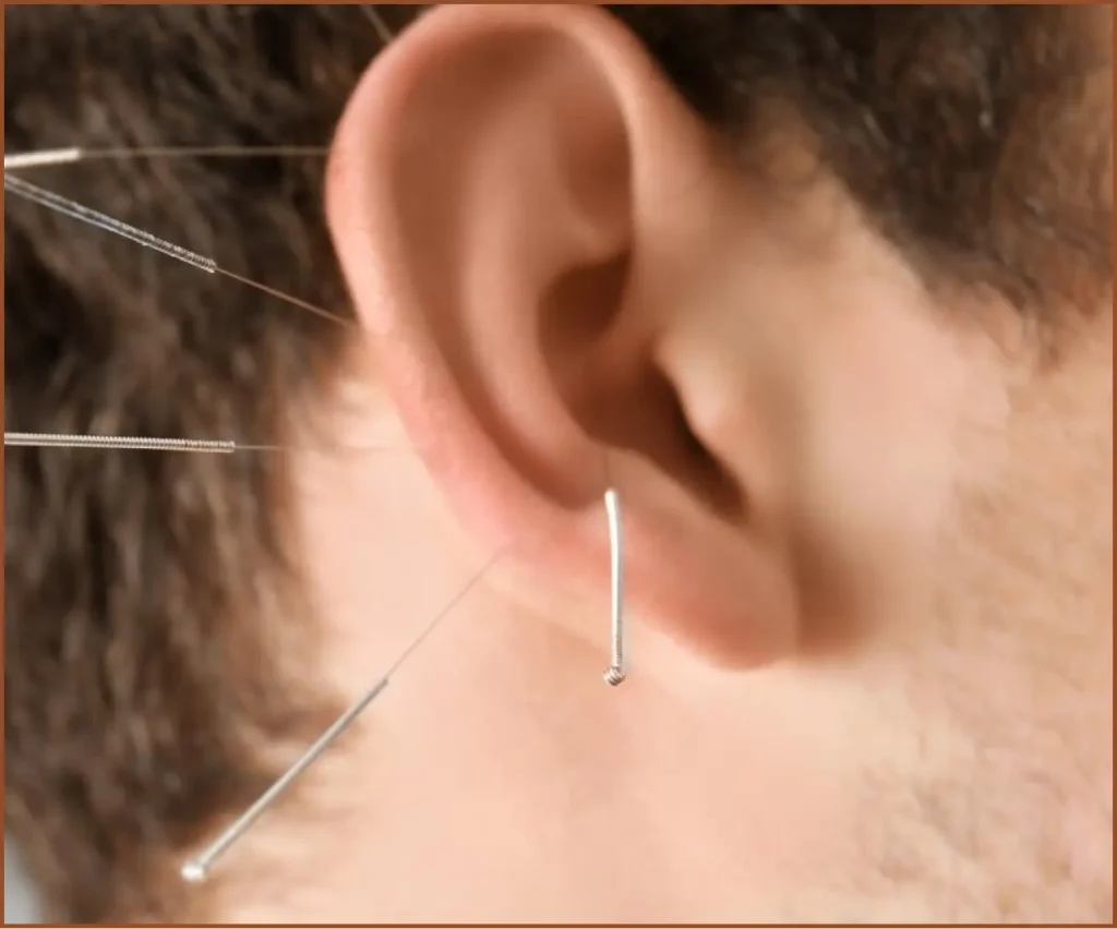 acupuncture on ear