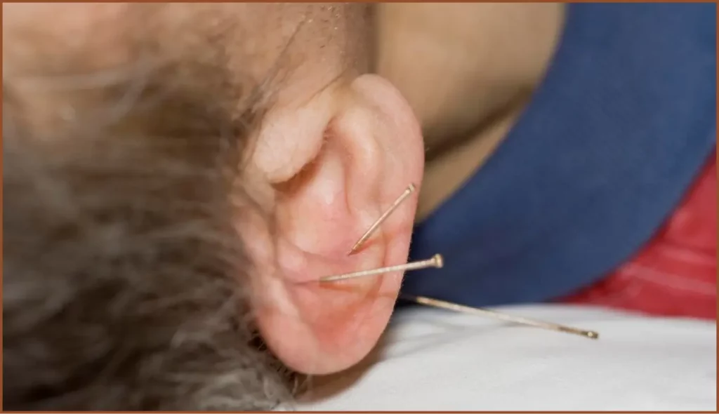 ear acupuncture in Kuna, ID