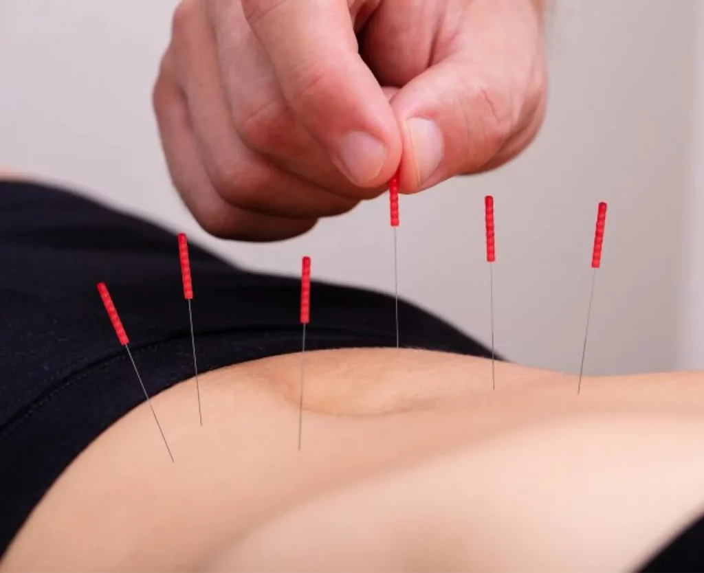 electro acupuncture therapy